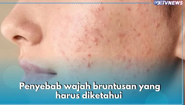 bruntusan di wajah - Kapan Sebaiknya Konsultasi ke Dokter Kulit