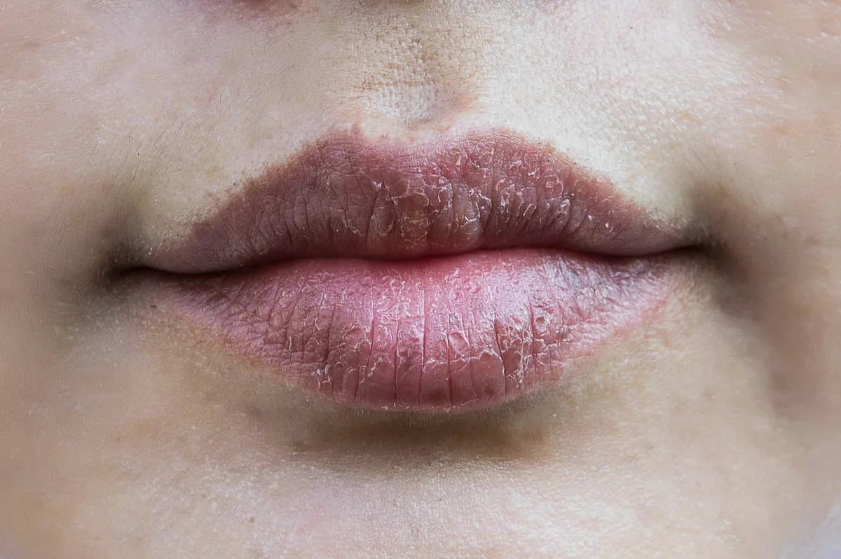 penyebab bibir kering dan pecah - Mengapa Mengupas Bibir Justru Memperburuk Keadaan