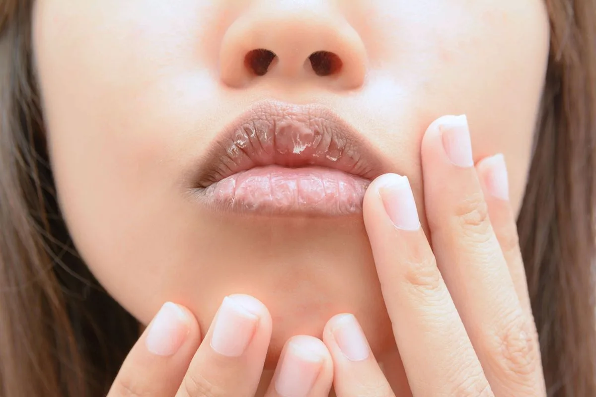 penyebab bibir kering dan pecah