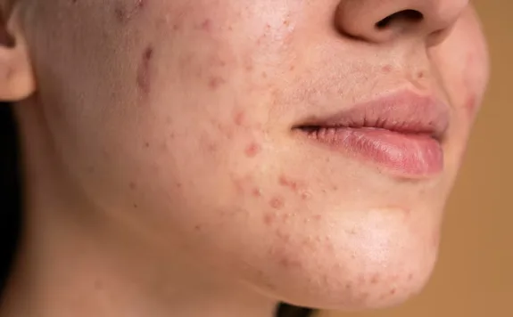 jerawat di hidung