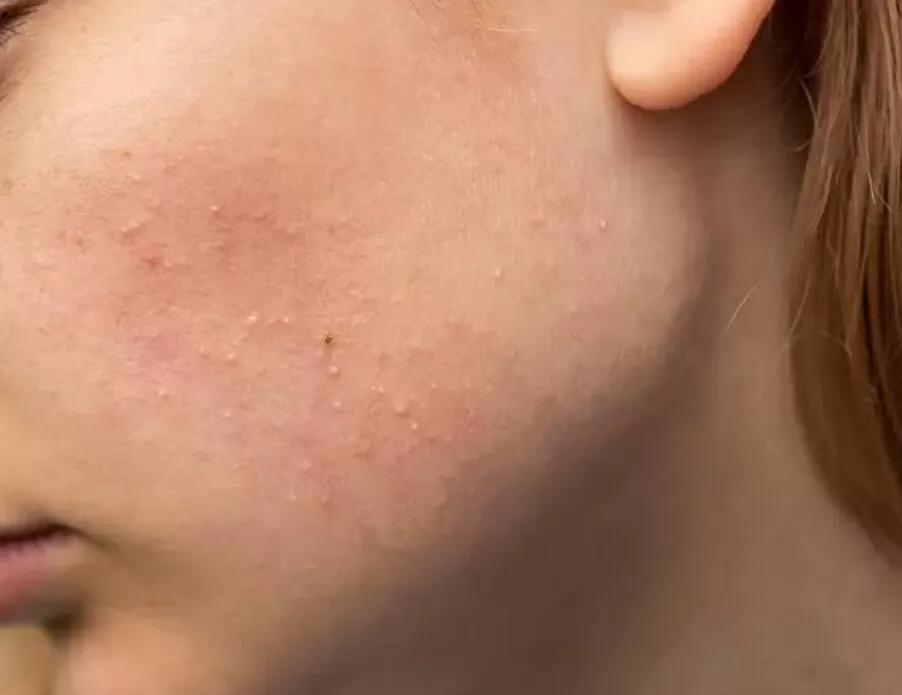 bruntusan di wajah - Panduan Memilih Skincare untuk Bruntusan Berdasarkan Jenis