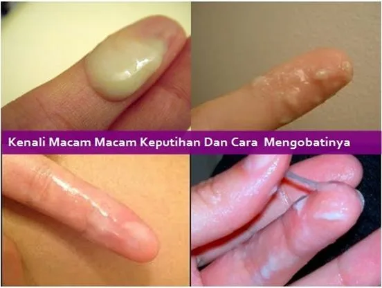 mengatasi keputihan gatal dan berbau