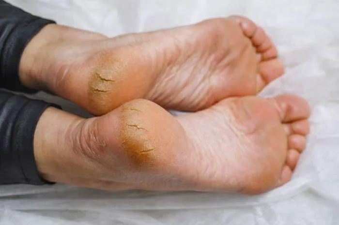 mengatasi tumit kaki pecah pecah
