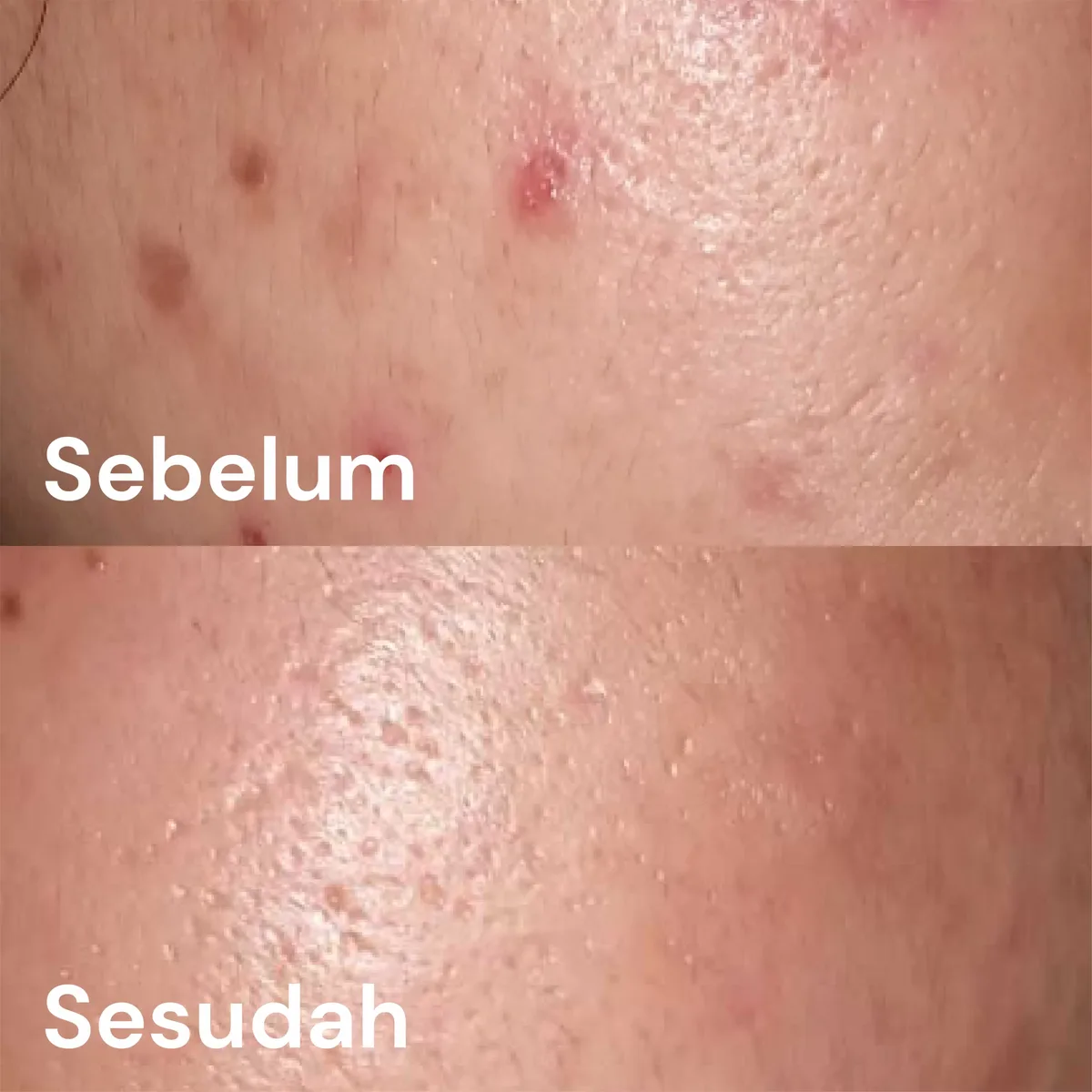 Kesalahan Umum yang Membuat Bekas Jerawat Kemerahan Makin