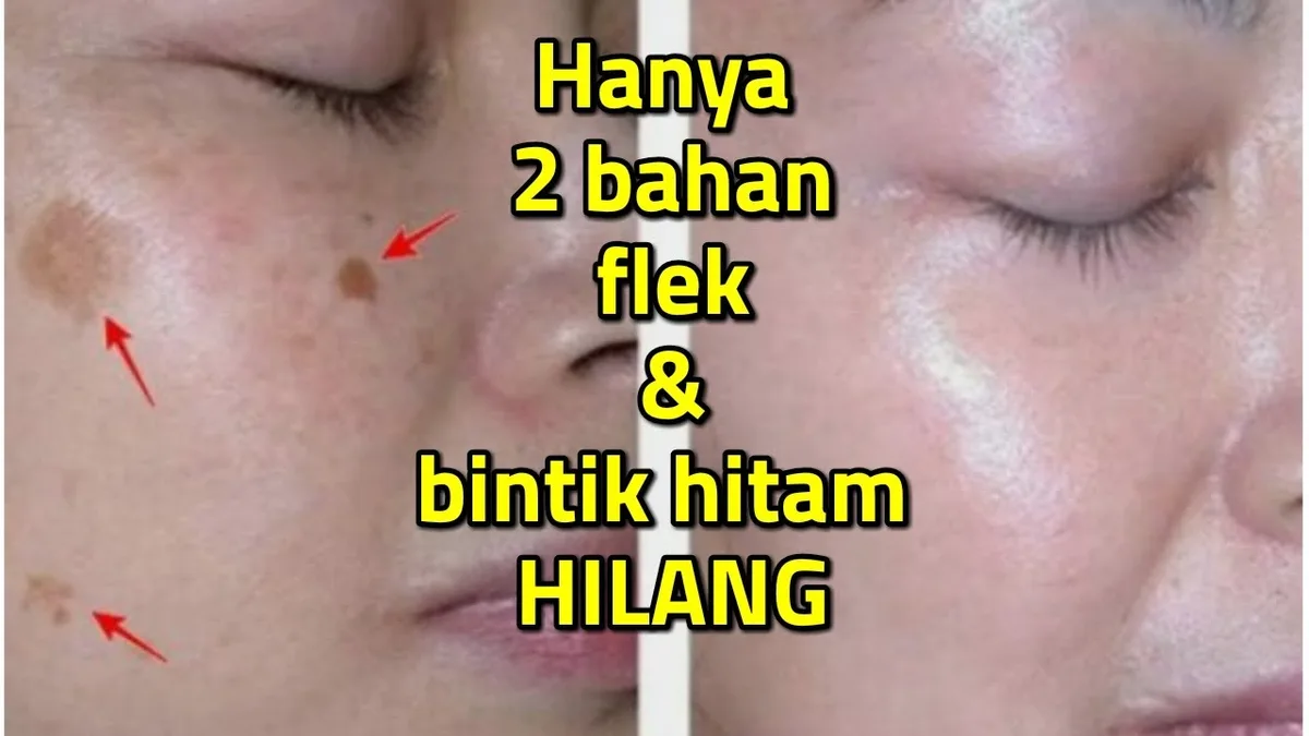 menghilangkan flek hitam di wajah - Kenali Jenis Flek Hitam di Pipi dan Area Wajah Lain