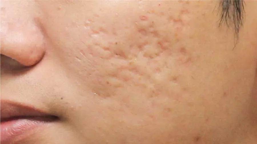 bekas jerawat kehitaman - Skincare untuk Bekas Jerawat Hitam: Menyusun Rutinitas