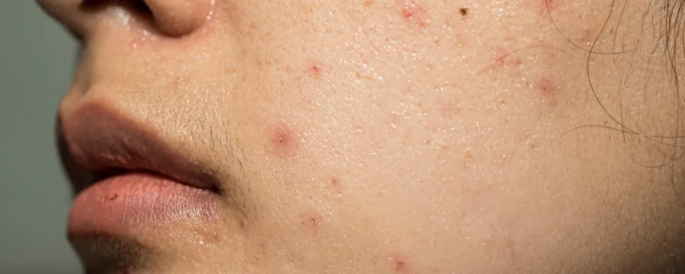 jerawat di hidung