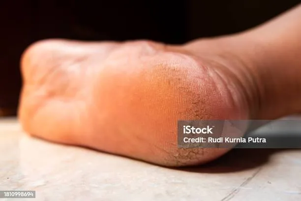 mengatasi tumit kaki pecah pecah