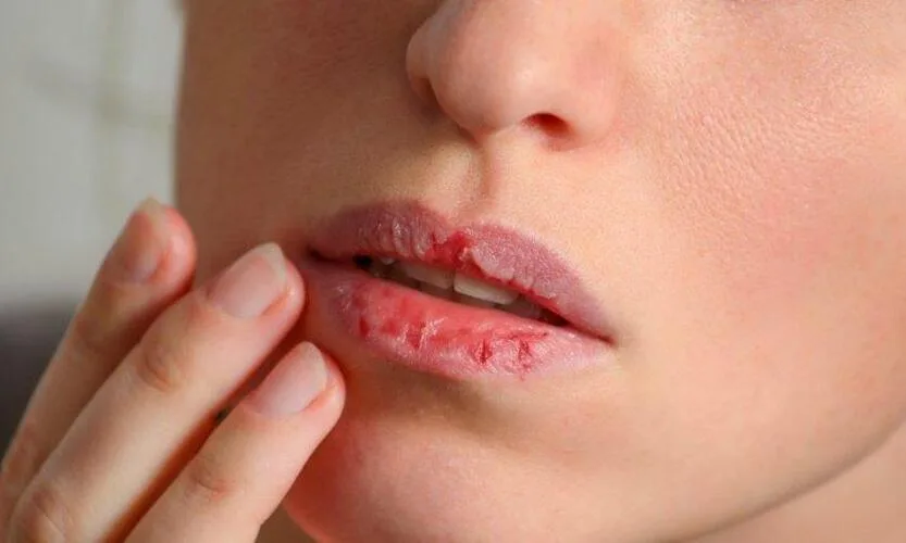 penyebab bibir kering dan pecah: Penutup: Rawat, Jangan Dikupas