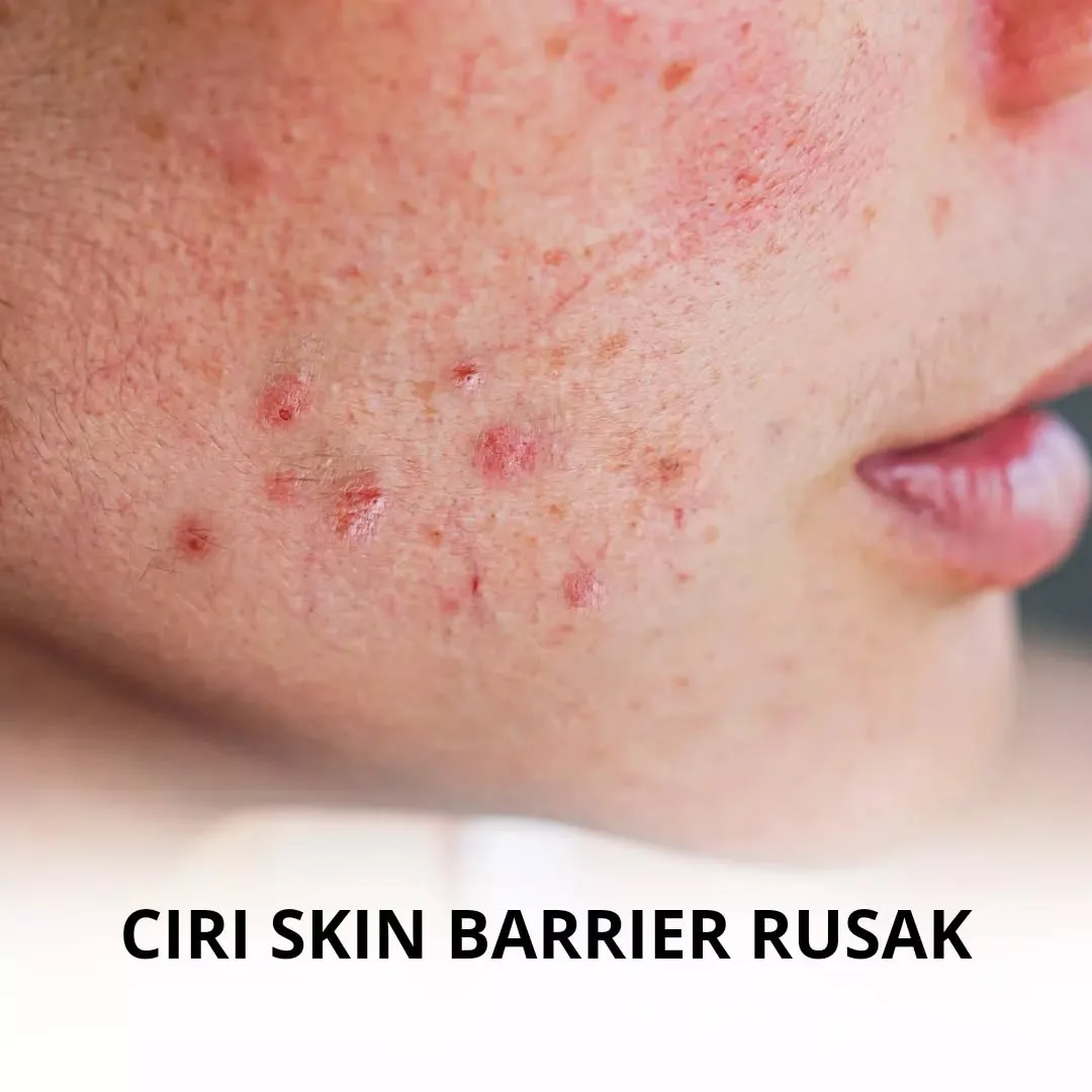 Pertanyaan Umum Seputar Skin Barrier Rusak