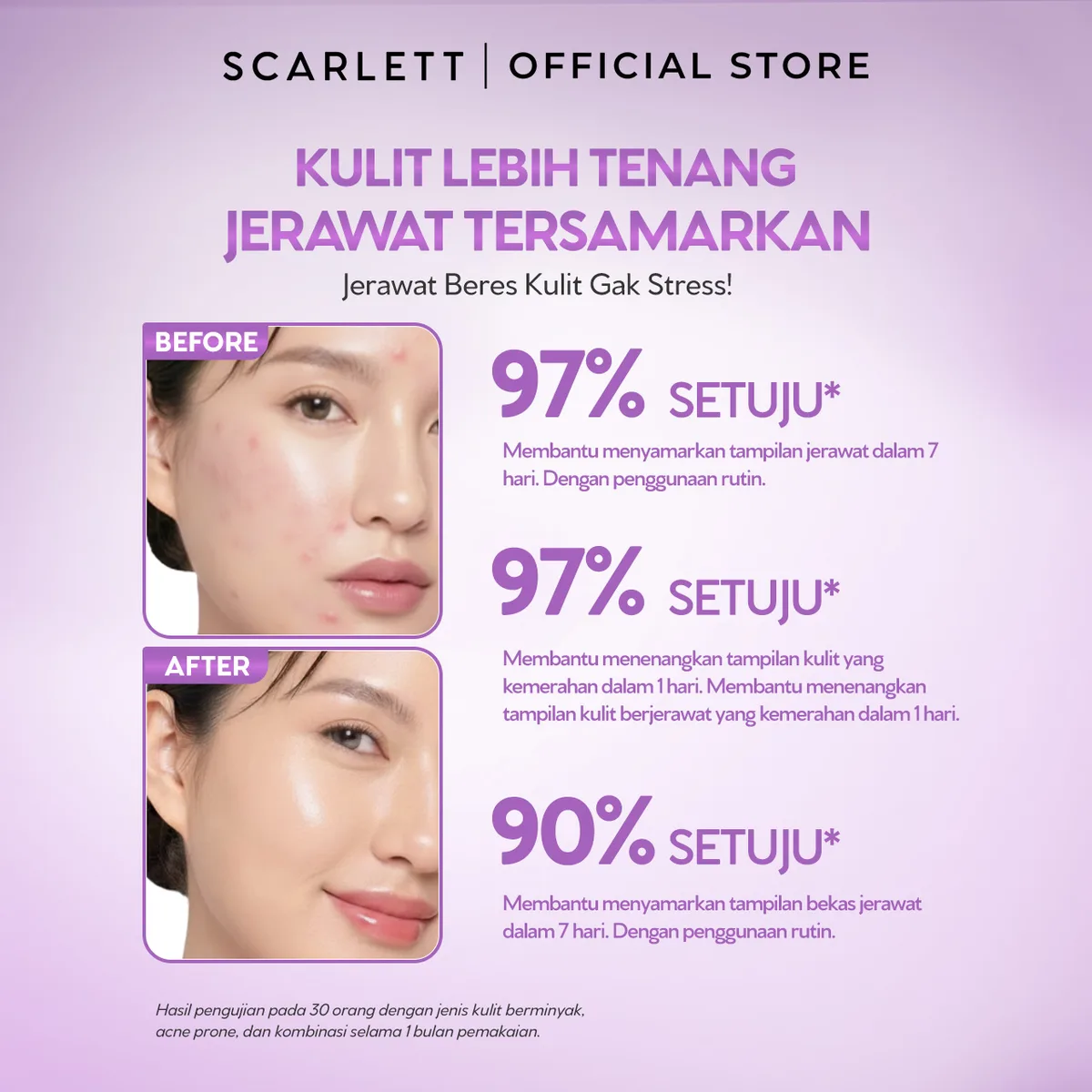 salicylic acid untuk jerawat: Berapa Lama Salicylic Acid Bekerja dan Kapan Hasilnya