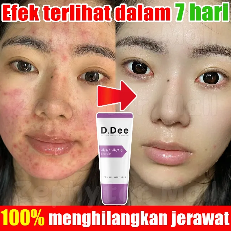 Pertanyaan yang Sering Diajukan tentang Obat Jerawat Batu