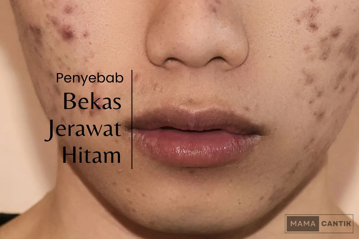 bekas jerawat kehitaman