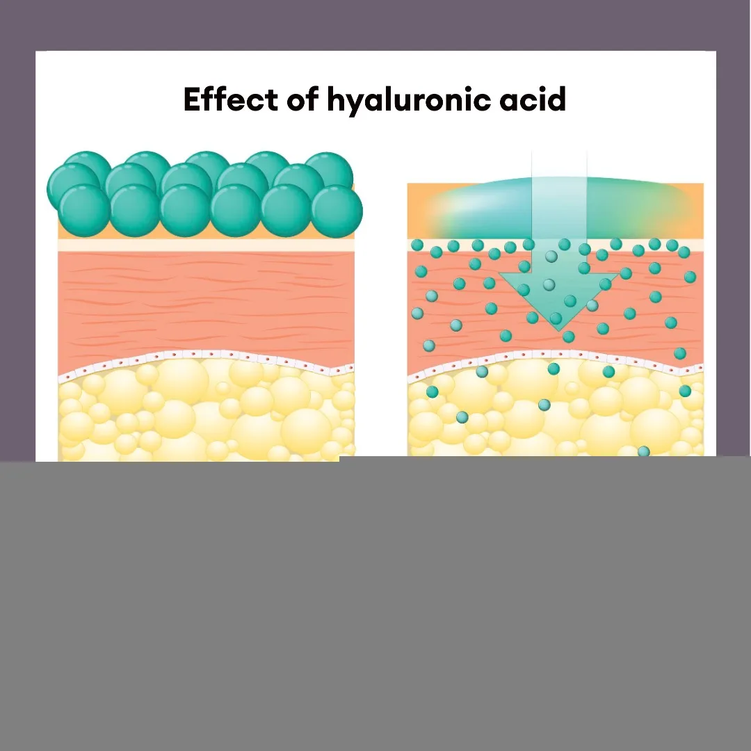 hyaluronic acid untuk melembabkan: Mengapa Kulit Kering dan Dehidrasi Butuh Pendekatan Berbeda