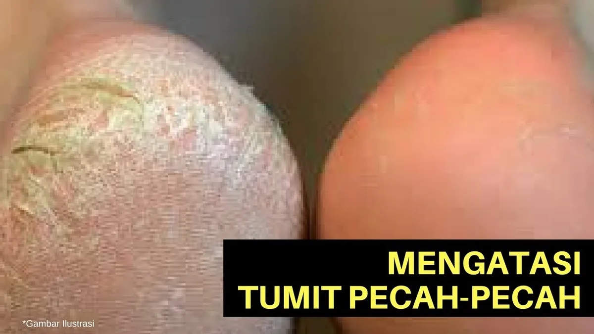 mengatasi tumit kaki pecah pecah - Cara Kelima: Menggunakan Obat Tumit Kaki Pecah Sesuai