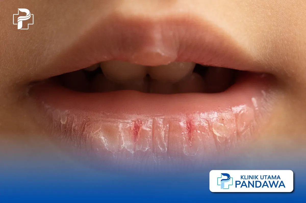 Memahami Penyebab Bibir Kering dan Pecah sebelum Memilih