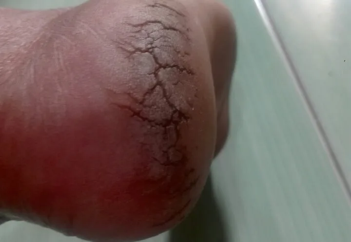 mengatasi tumit kaki pecah pecah
