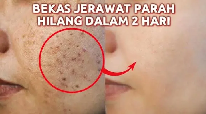 bekas jerawat kehitaman