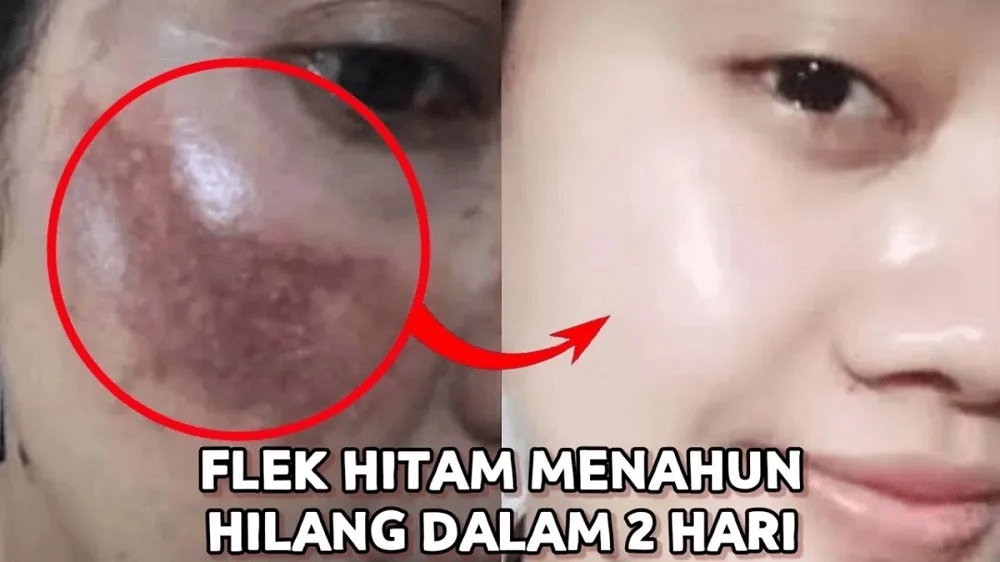 menghilangkan flek hitam di wajah: Langkah Praktis Memulai Perjalanan Menghilangkan Flek