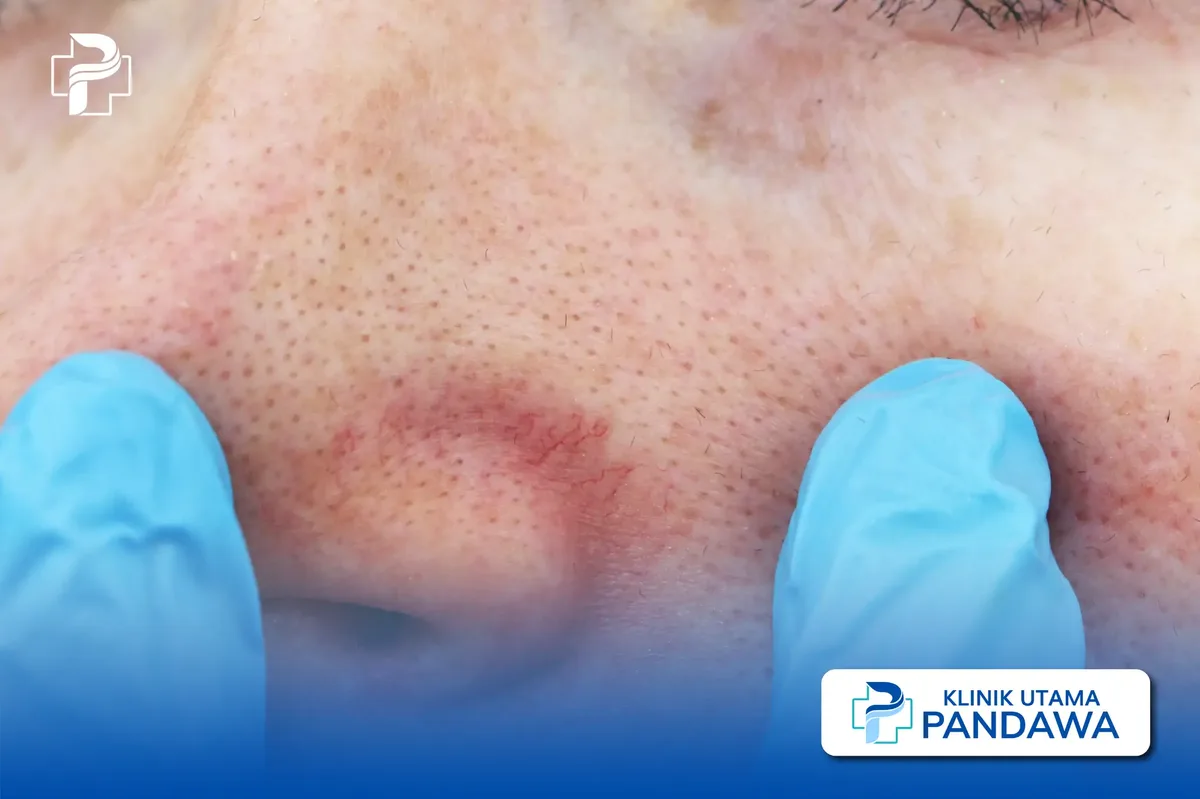 Mengenal Jerawat di Hidung dan Arti Kemunculannya