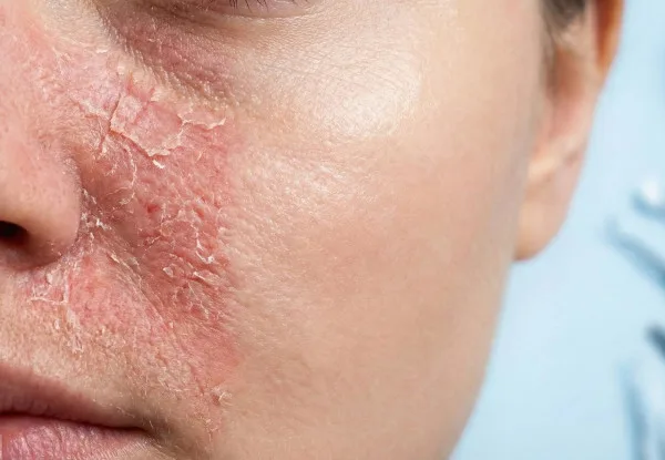 7 Tanda Skin Barrier Rusak yang Sering Diabaikan
