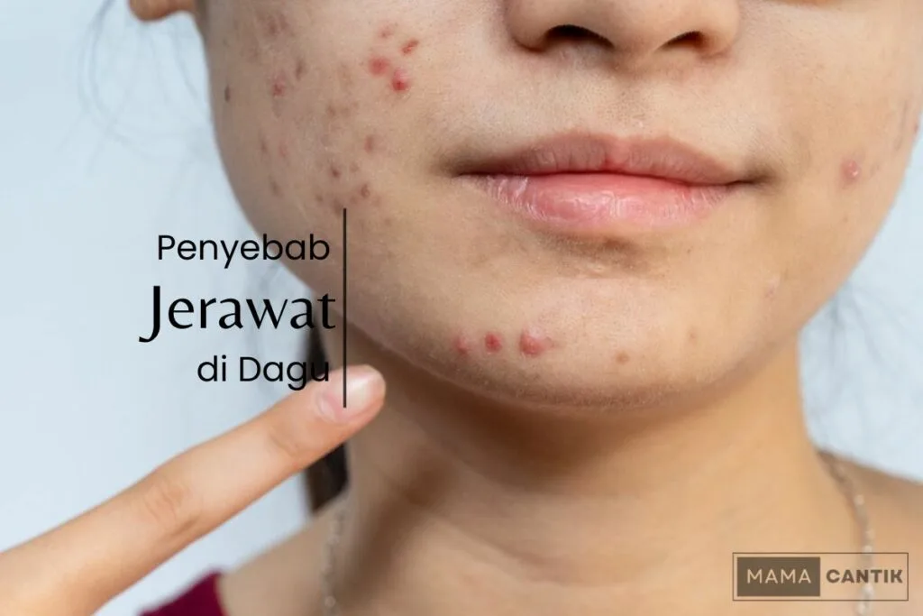 jerawat di dagu