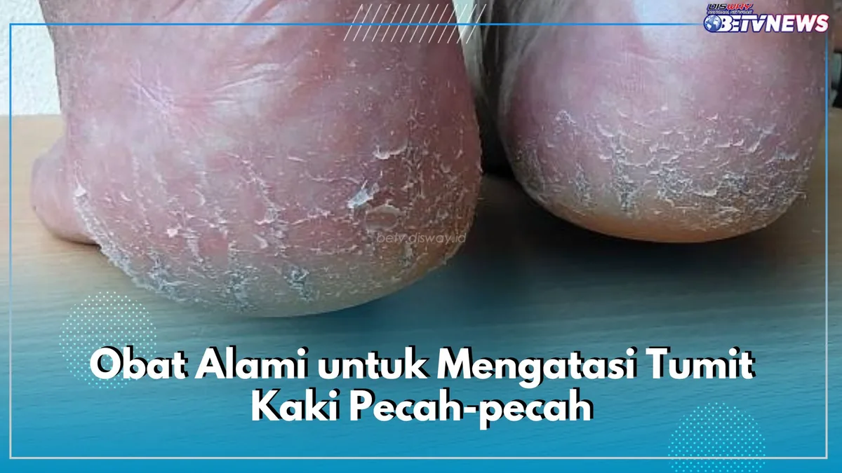 mengatasi tumit kaki pecah pecah - Kenapa Tumit Kaki Mudah Pecah-Pecah? Mengungkap Penyebab