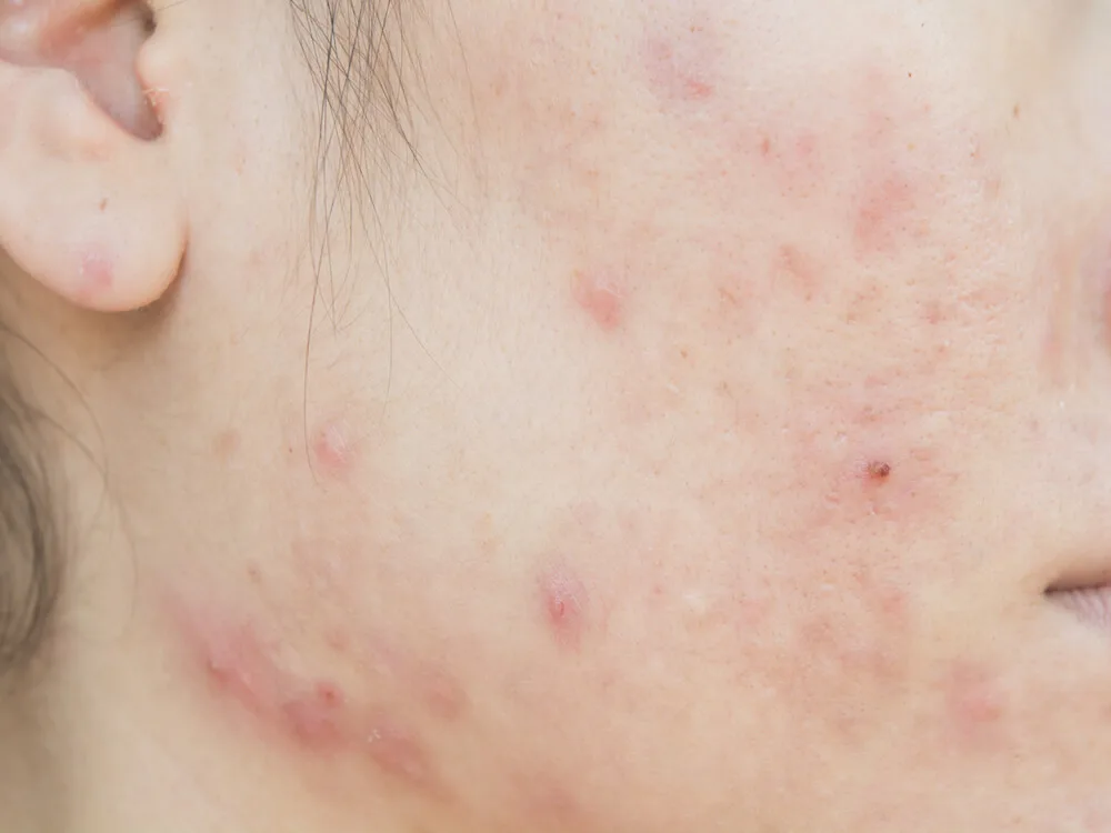 bekas jerawat kemerahan: Peran Serum Pemudar Bekas Jerawat dalam Rutinitas