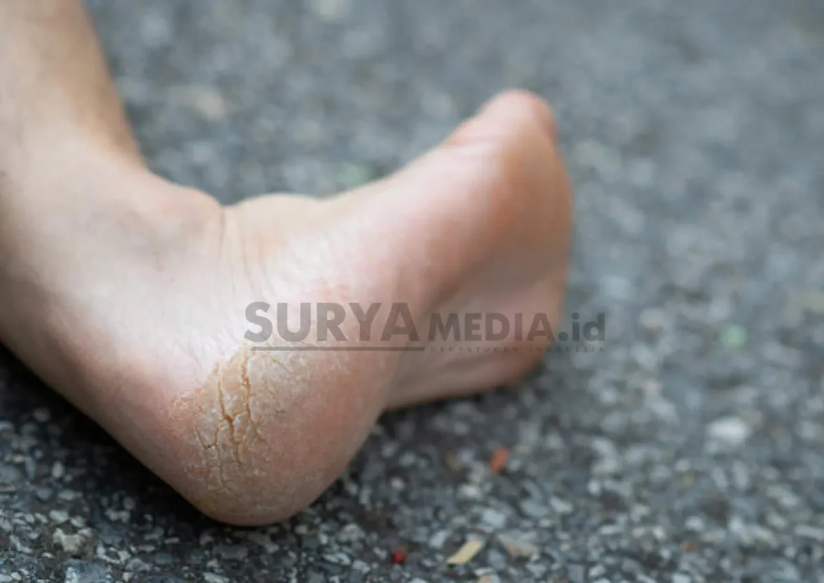 mengatasi tumit kaki pecah pecah