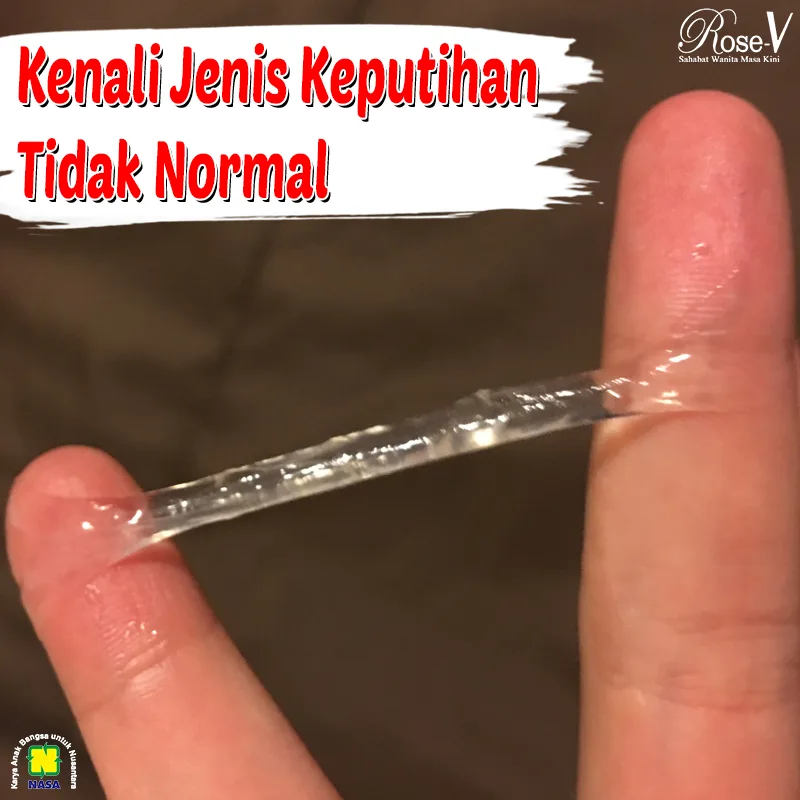 keputihan normal dan tidak normal: Penyebab Keputihan Abnormal dari Sudut Pandang Medis
