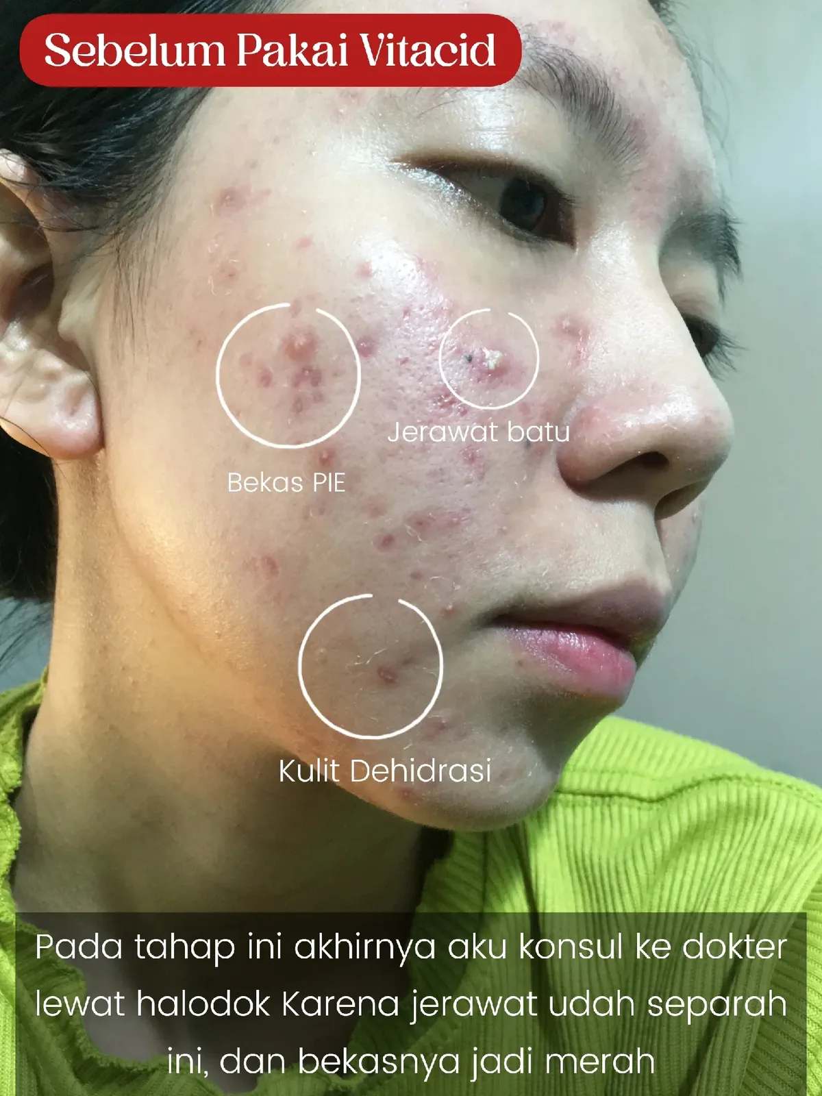 obat jerawat batu
