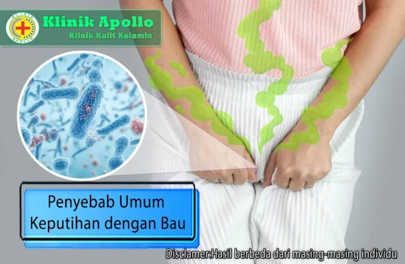 mengatasi keputihan gatal dan berbau