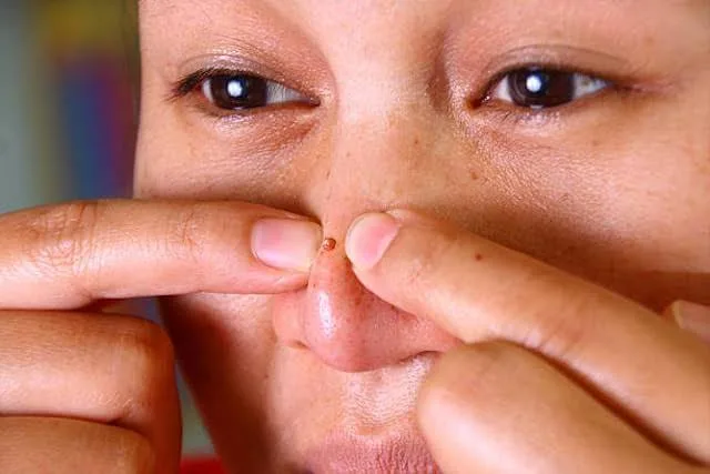 jerawat di hidung