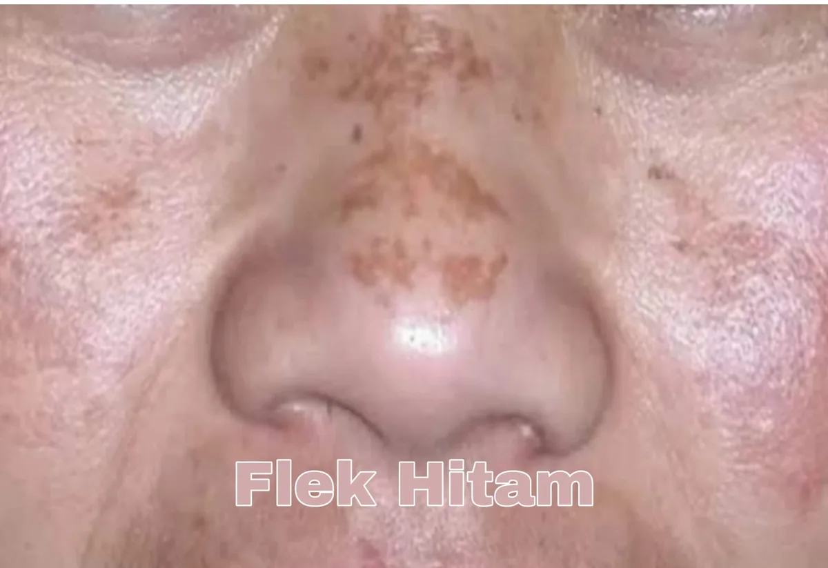 menghilangkan flek hitam di wajah