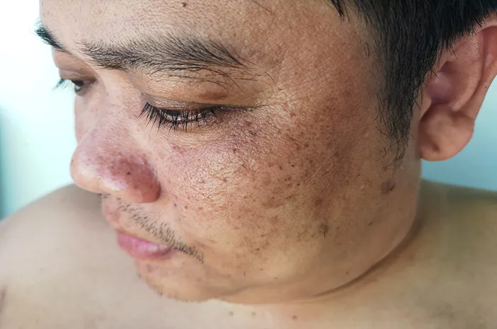 menghilangkan flek hitam di wajah