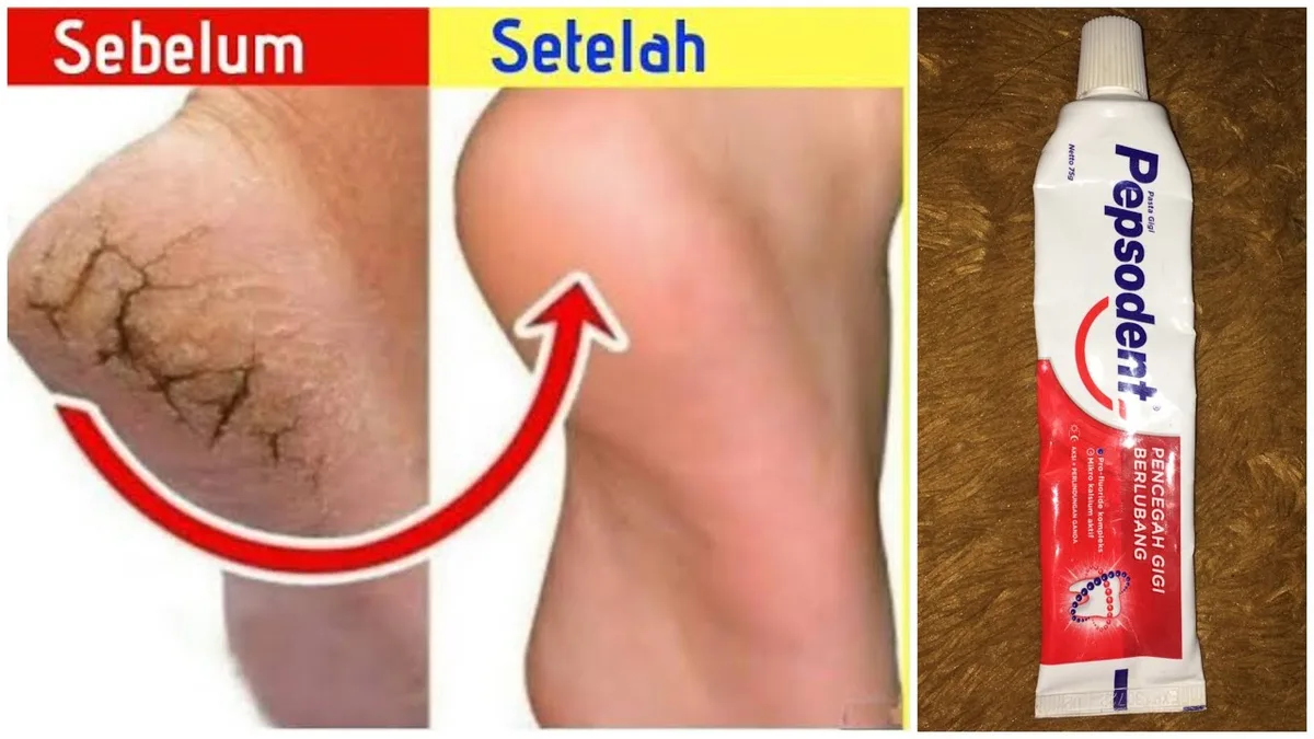 mengatasi tumit kaki pecah pecah: Pertanyaan Umum tentang Merawat Tumit Pecah-Pecah