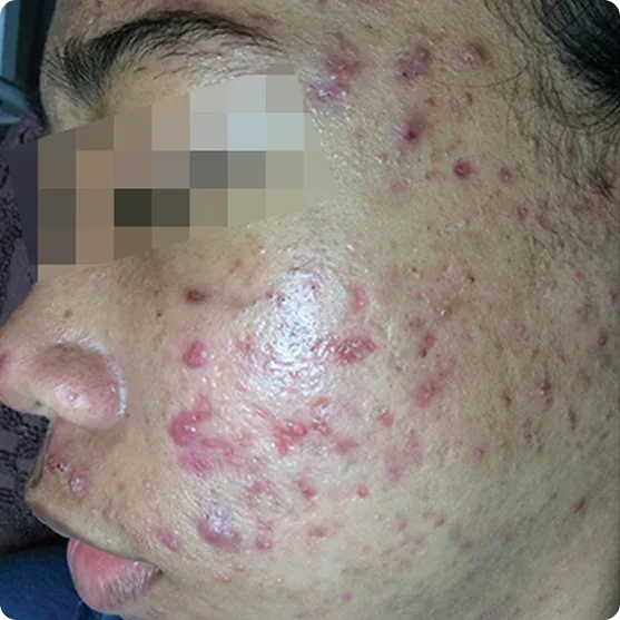 bekas jerawat kemerahan: Bahan Aktif yang Terbukti Membantu Cara Menghilangkan PIE