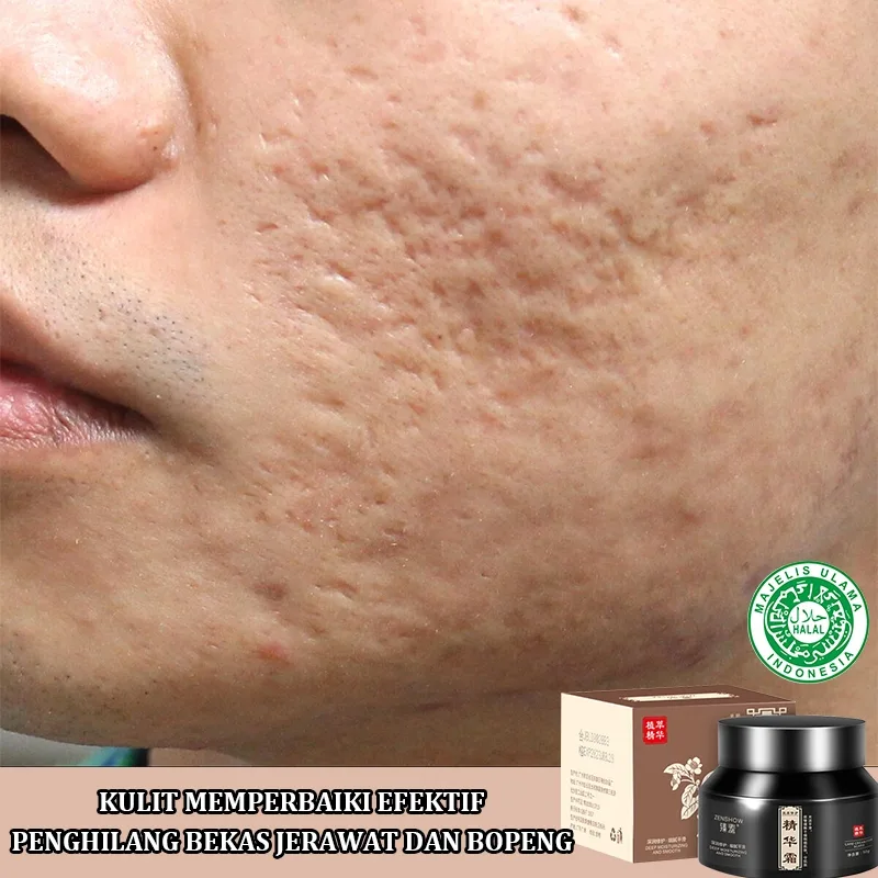 bopeng bekas jerawat - Memahami Penyebab Bopeng Jerawat sebelum Memilih Cara
