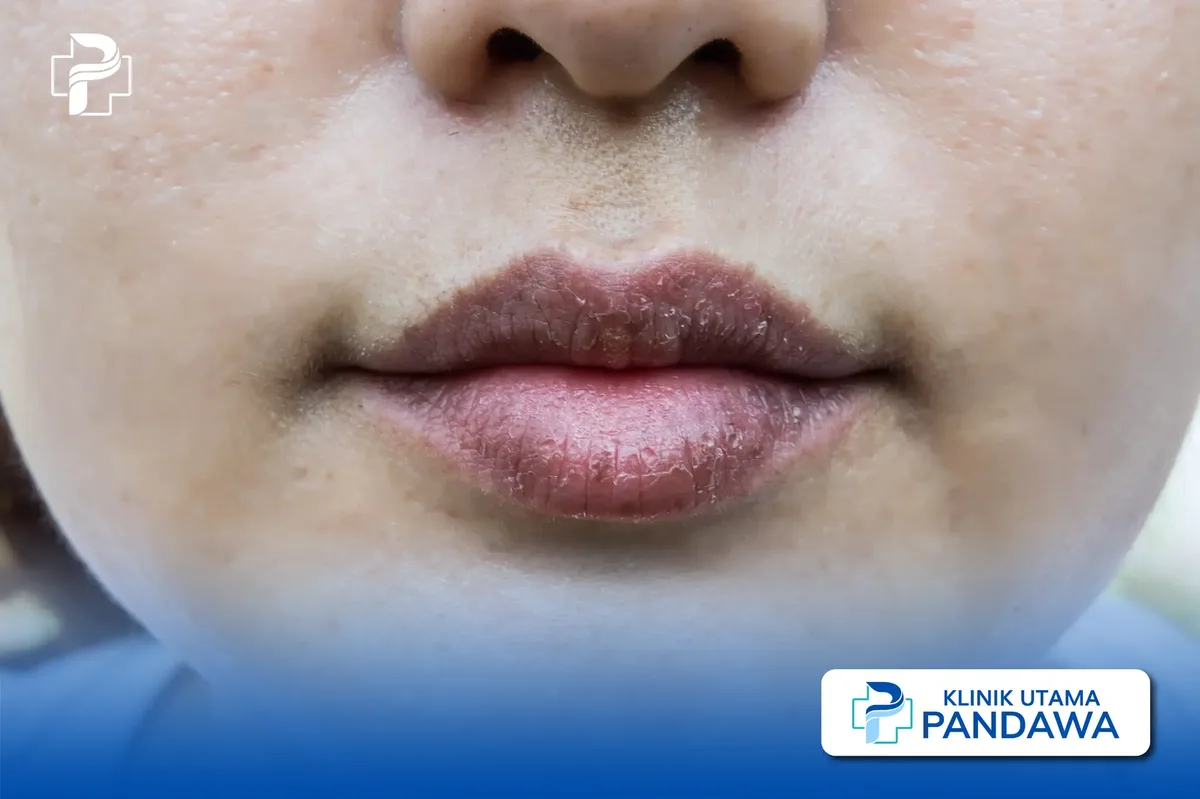 cara merawat bibir hitam