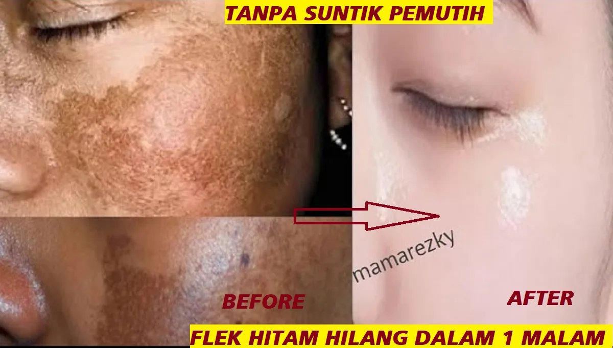 menghilangkan flek hitam di wajah: Pahami Dulu Akar Masalahnya sebelum Berburu Solusi