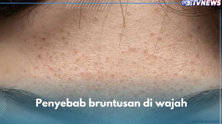 bruntusan di wajah: Bahan Alami yang Aman untuk Membantu Bruntusan Hilang Alami