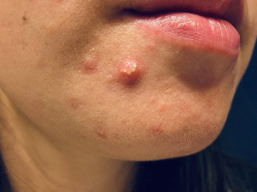 Kenapa Jerawat di Dagu Erat Kaitannya dengan Hormon?