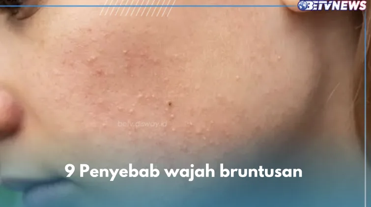 Pertanyaan yang Sering Muncul Seputar Bruntusan di Wajah