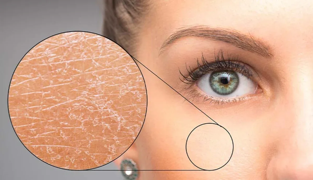 skin barrier rusak - Apa Itu Skin Barrier dan Mengapa Kerusakannya Berdampak