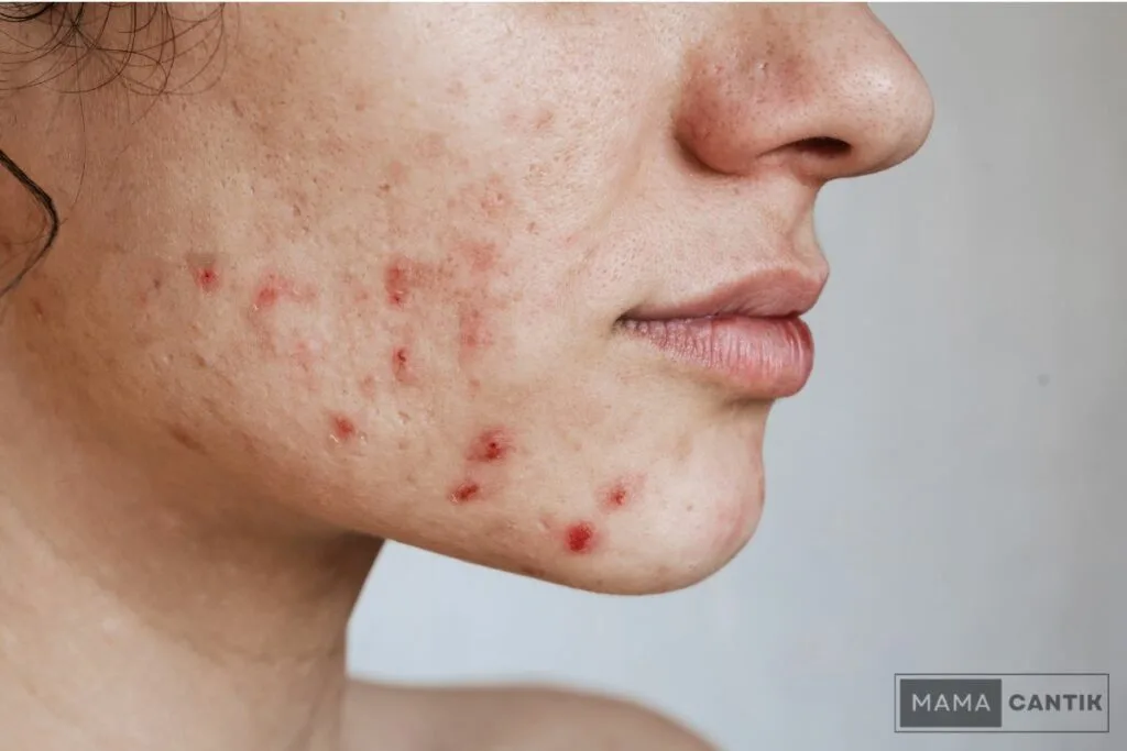 Perbandingan Bahan Aktif untuk Jerawat di Dahi